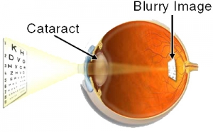 Causes of cataracts