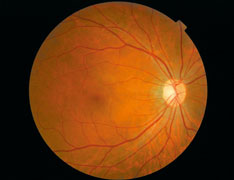 retinal-screening