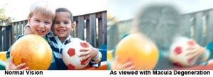 age related macular degeneration